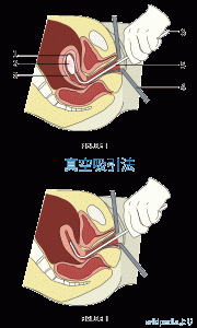 人工妊娠中絶手術方法例