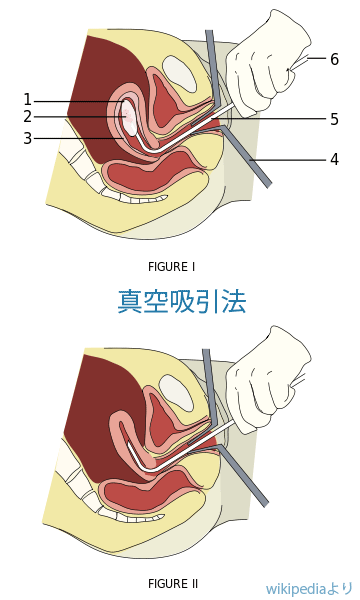 人工妊娠中絶手術方法例